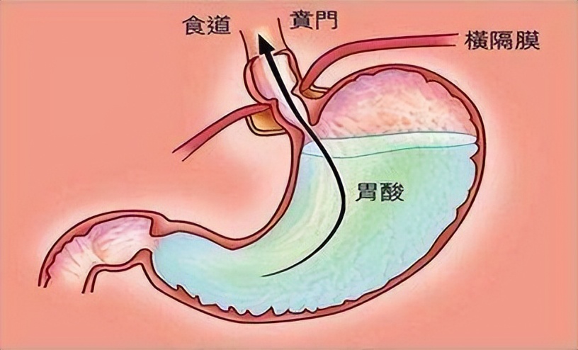 反酸、烧心吃花生管用吗？医生：尝试这3种方法或让胃变得舒服些