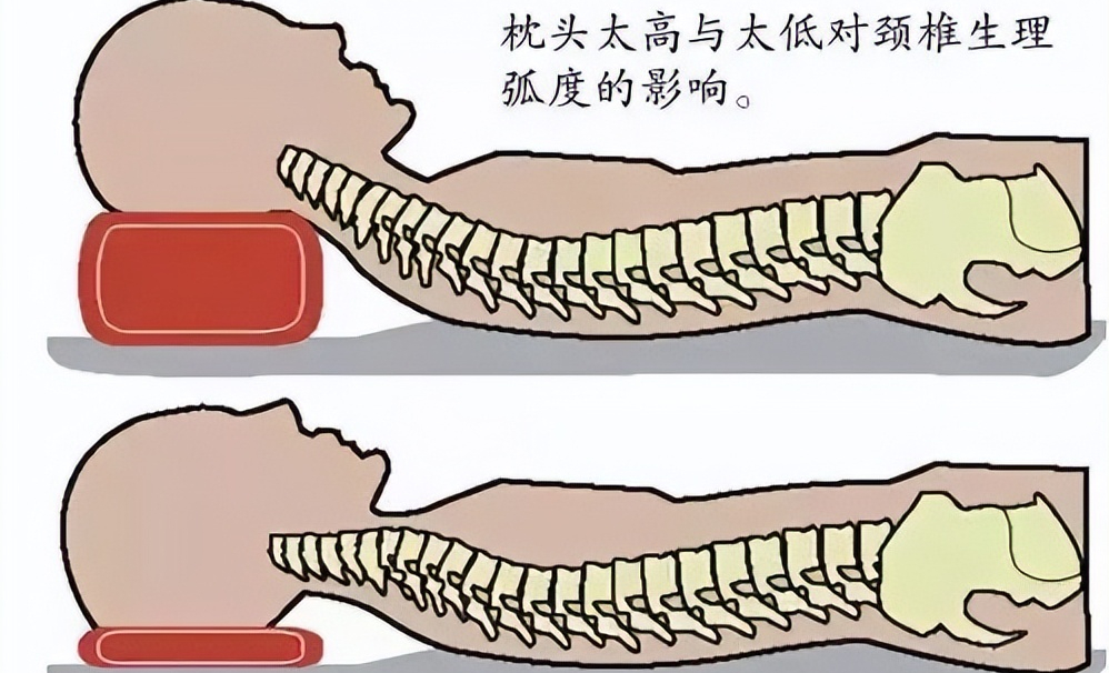 脖子后面凸一块是“富贵包”吗？如何消除？这3招简单又有效