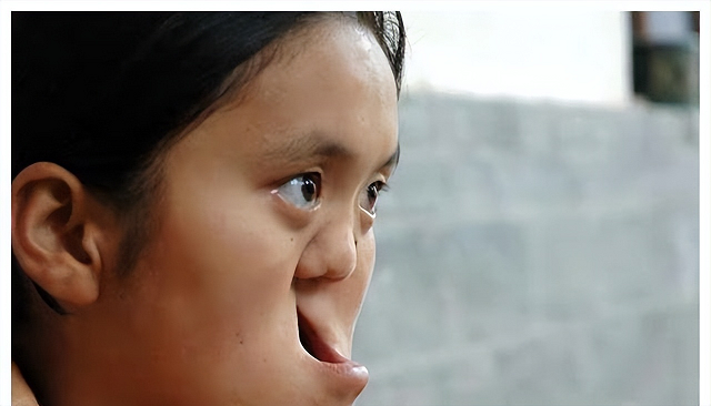 陕西农民捡到​坑面女婴，哥哥做苦力为妹妹整容，变美后她嫁给哥哥