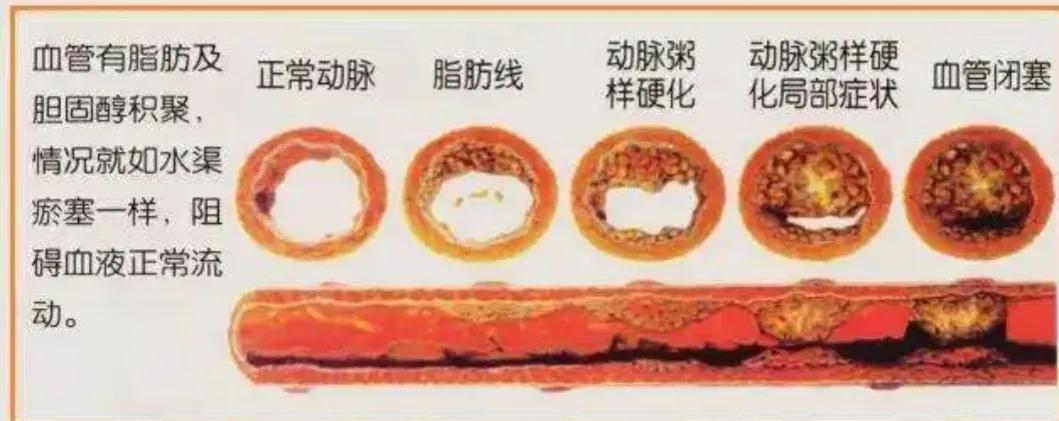 红酒、鱼油会软化血管？保护血管要做好以下3点，血管健康更长寿