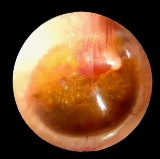 儿童耳聋的隐形疾病—分泌性中耳炎