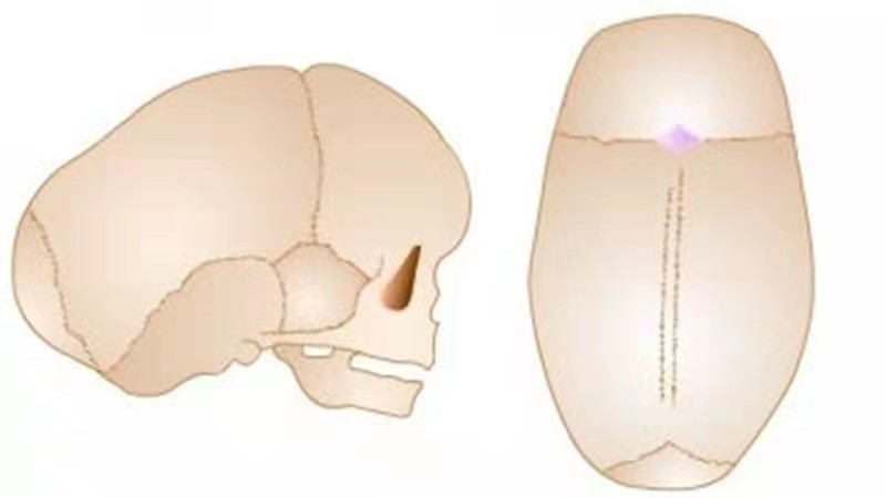 婴儿舟状头（宝宝出现的舟状头是怎么回事）