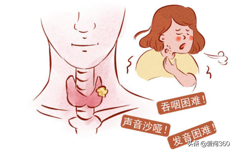 甲状腺有问题的几个表现，预防甲状腺结节的小妙招，你知道几个？