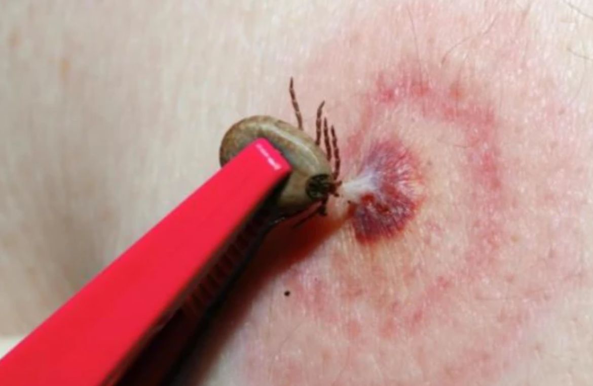 孩子被蜱虫咬了怎么办?妈妈巧用4步法处理,医生:回家观察即可