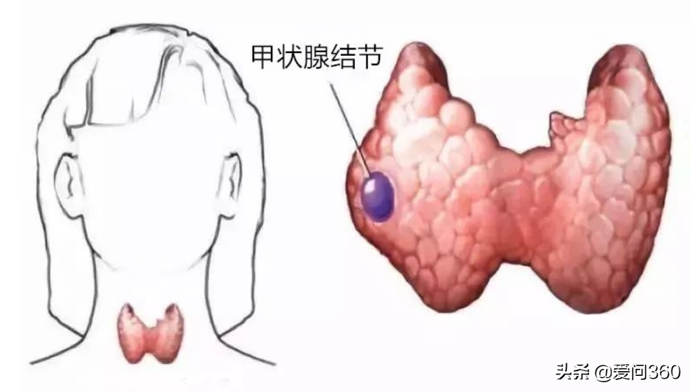 甲状腺有问题的几个表现，预防甲状腺结节的小妙招，你知道几个？