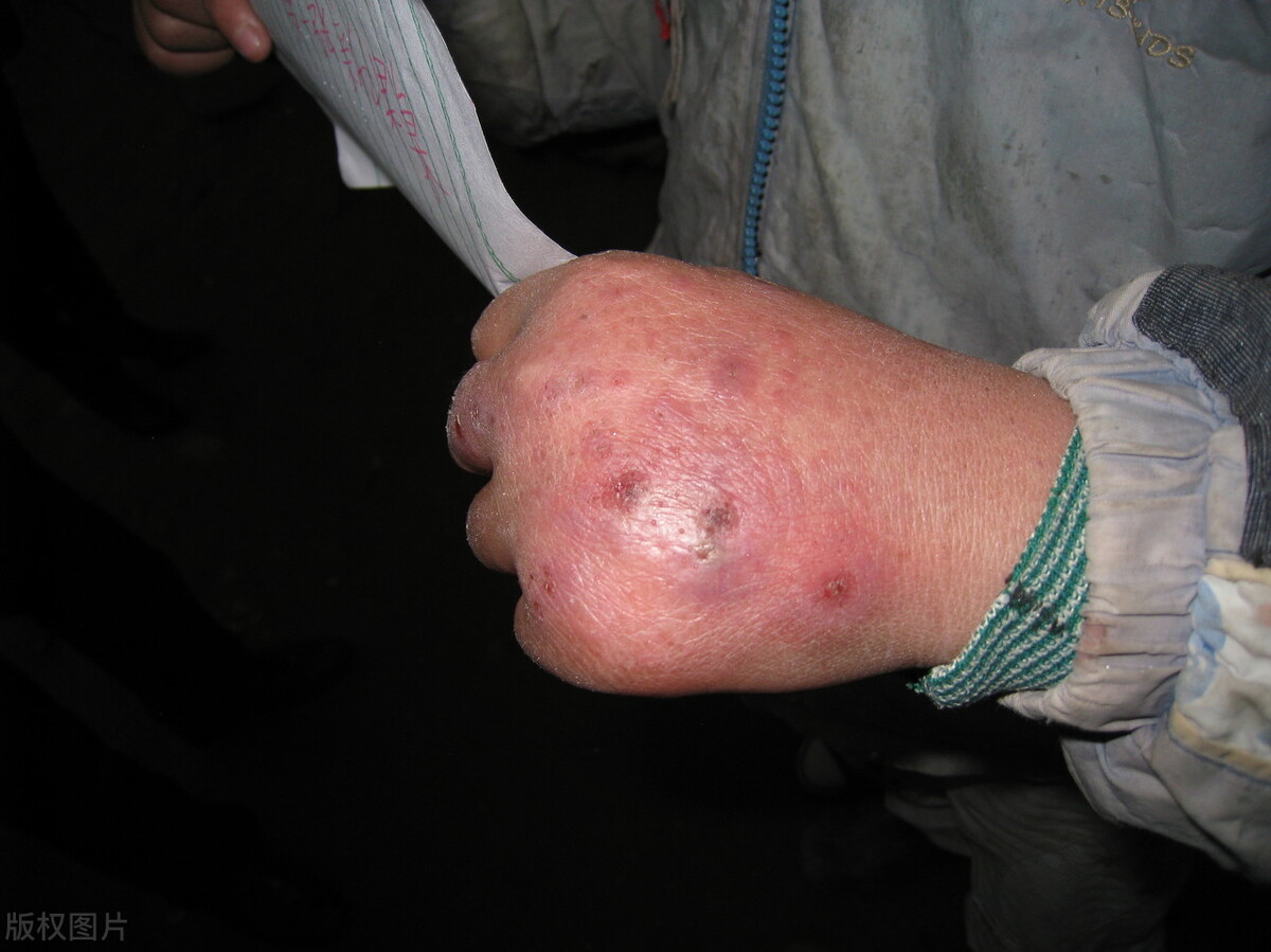 冰疮最初的症状图片(为什么冬天会长冻疮) - 赤虎壹号