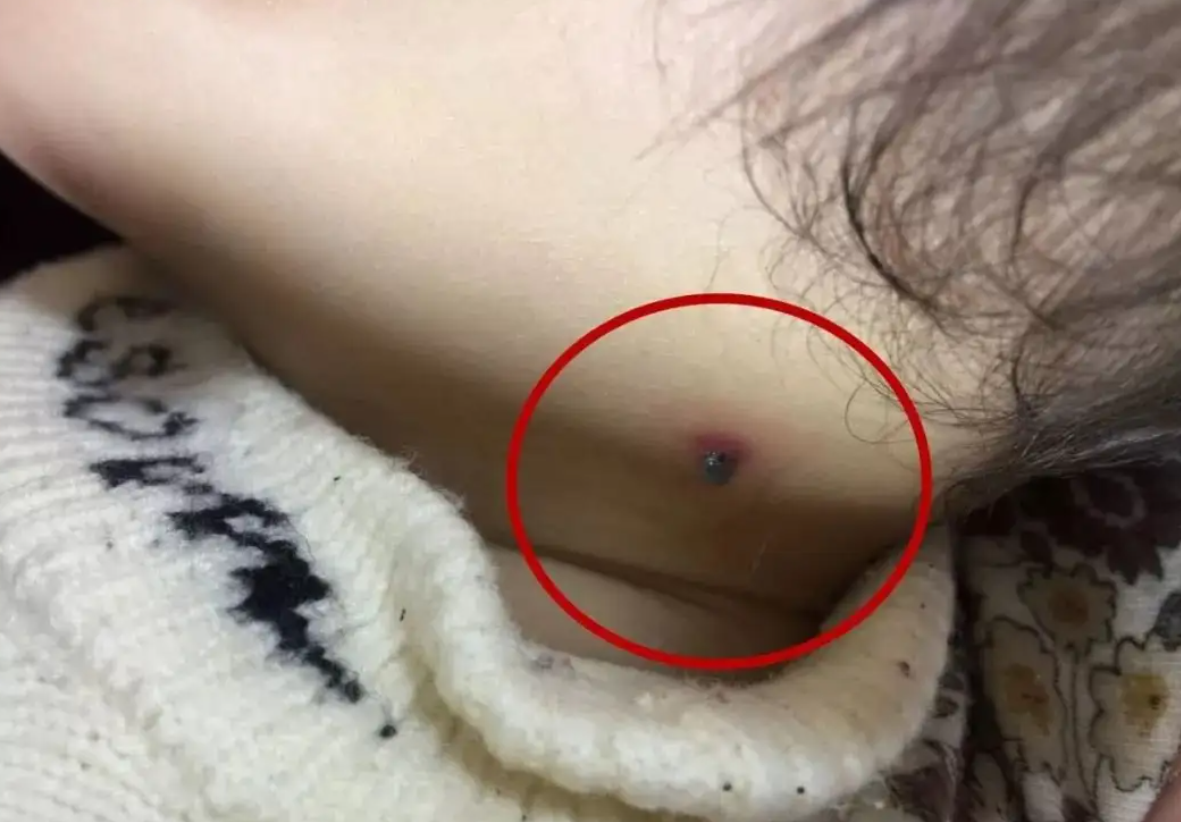 小孩肚子里的蛔虫图片(4岁孩子被蜱虫咬) - 赤虎壹号