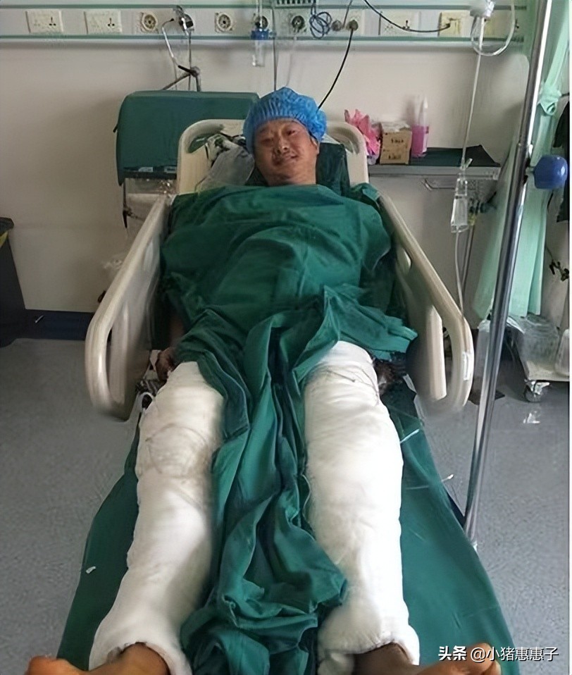 比杨幂眼角受伤更惨烈8位明星：烧伤、毁容、中弹、瘫痪、丧命