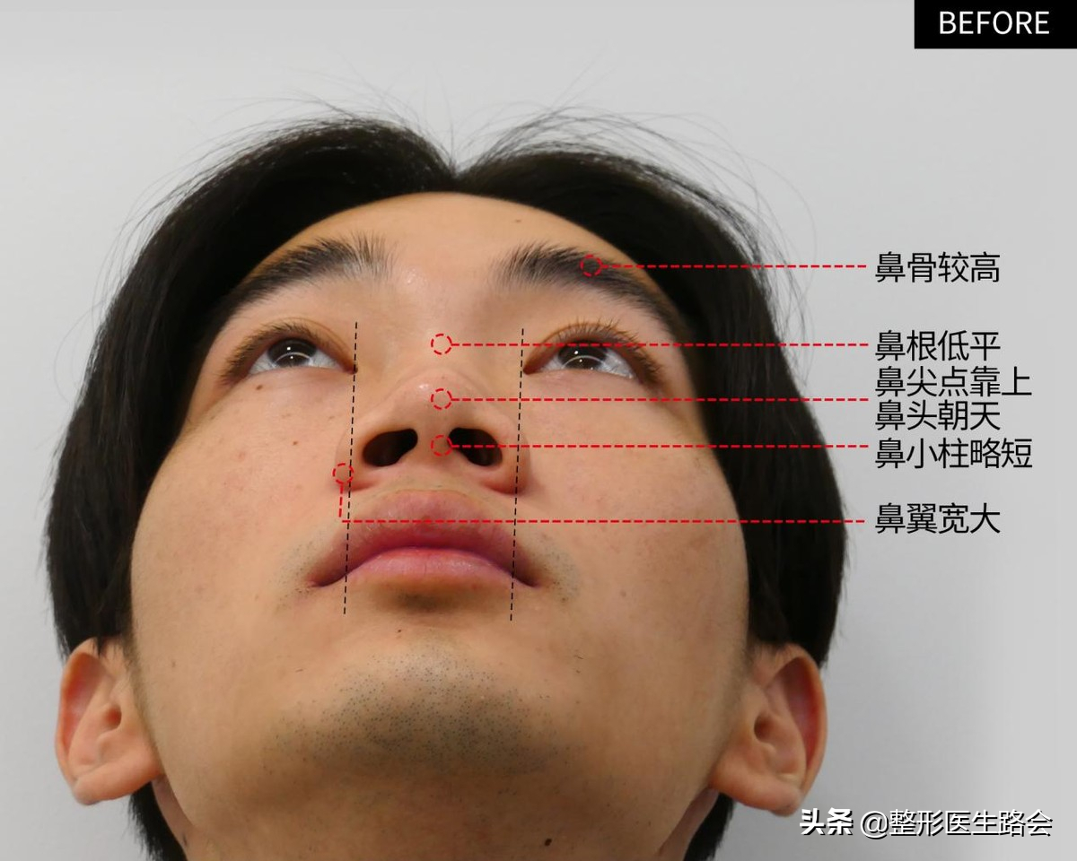 等待2年之久，从海南到北京，鼻整形真实记录，82天后“很惊艳”