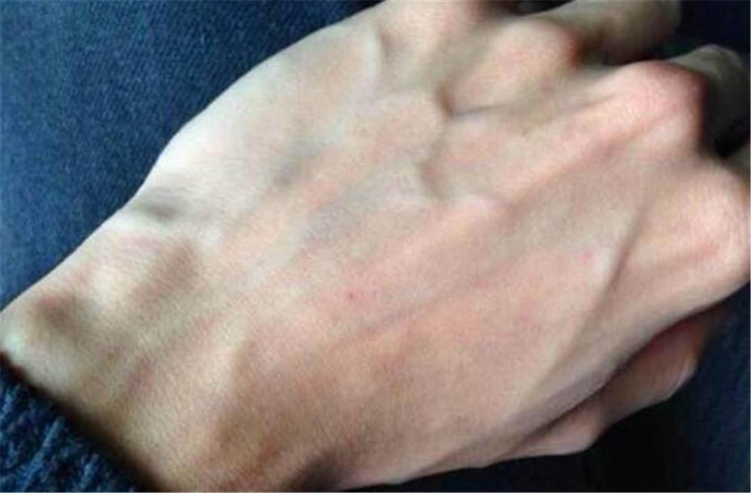 手上有很多青筋凸起，是因为毒素积累导致的吗？看看不一样的说法