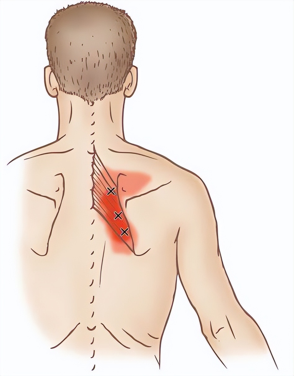 菱形肌疼？肩胛骨中间疼？重视这三点，才能从根本上改善
