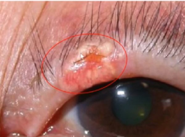 睑板腺癌又称麦氏腺癌,是眼睑较常见的恶性肿瘤,来源于睑板腺和睫毛的