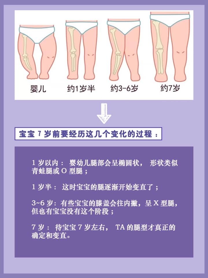 宝宝出现O型腿，尿不湿：这个锅我可不背