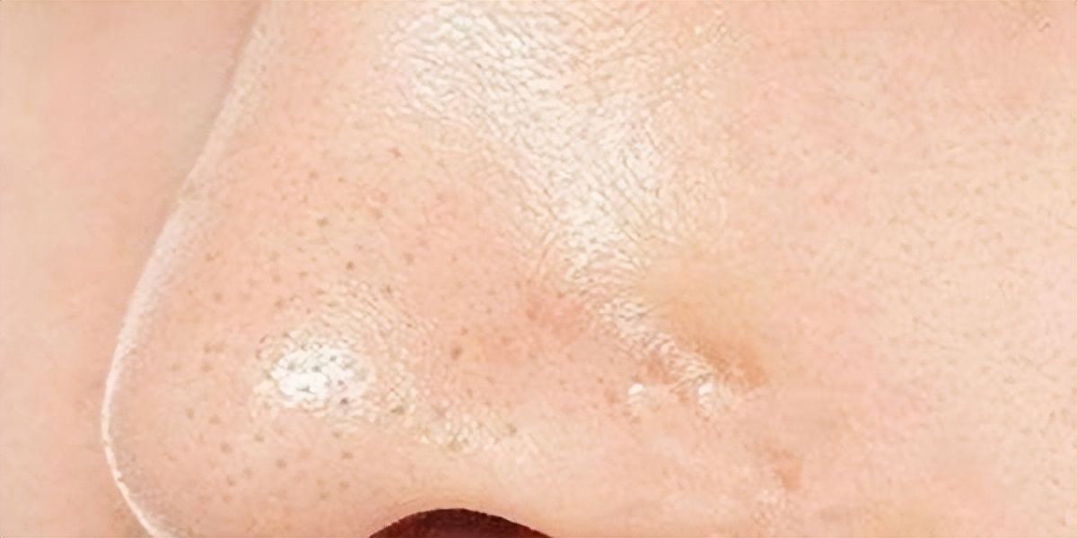 怎样疏通堵塞毛孔,修复受损毛囊,补充水分3