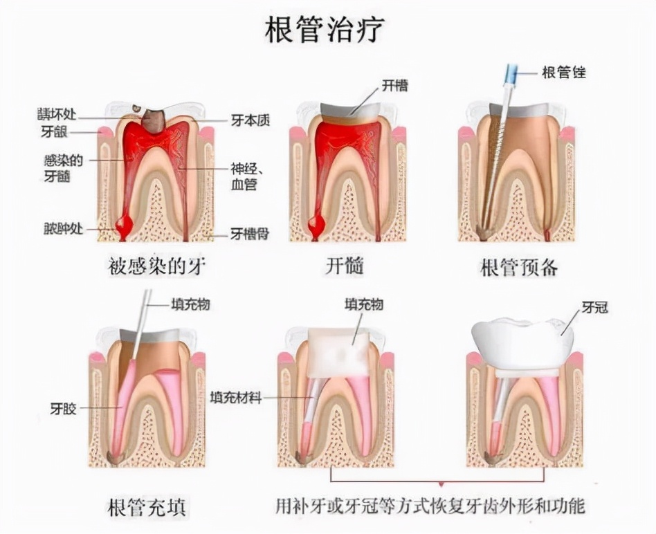 「牙齿那些事儿」No.79丨什么是根管治疗？根管后的牙齿能用多久