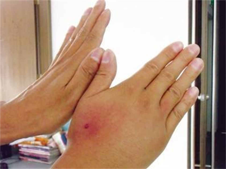 两男子强摘蜂巢造成1死1重伤,倒赔了26万