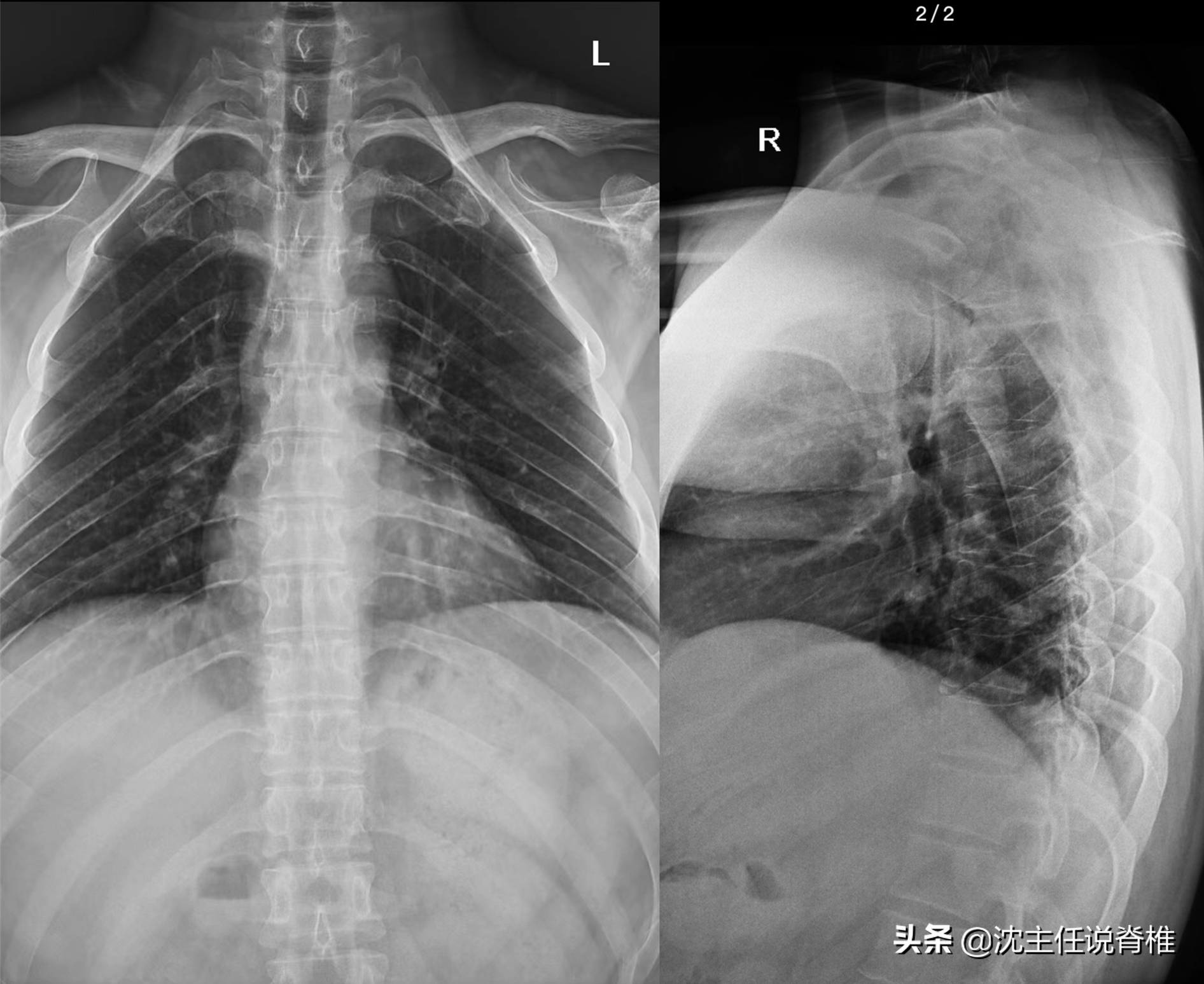 后背、肩胛骨内侧缘疼痛，排除了内科疾病，还要注意这个原因