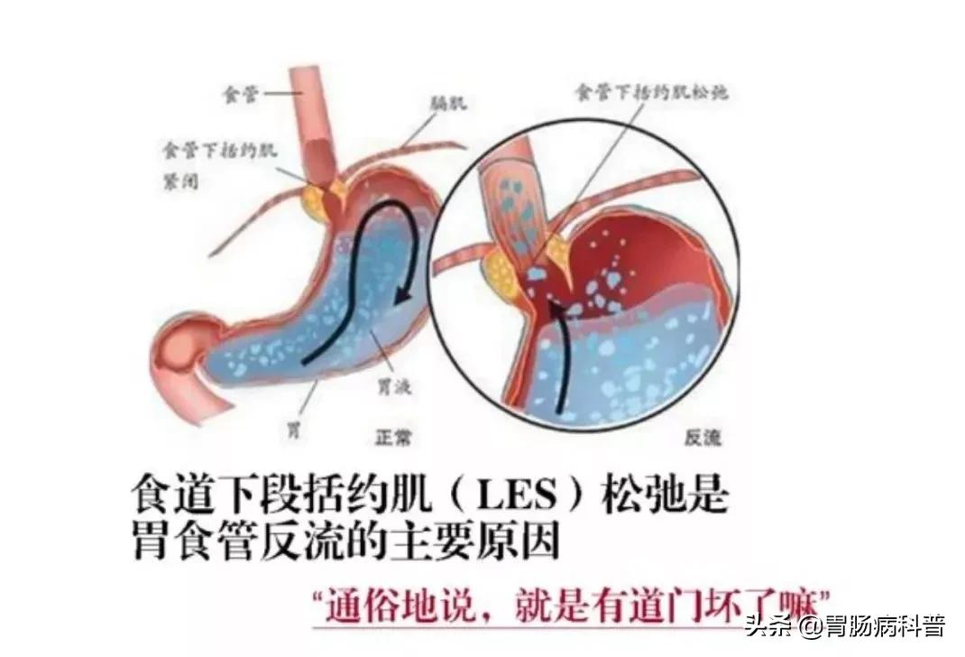 胃烧心治疗新进展：最新研究成果揭示有效缓解方法