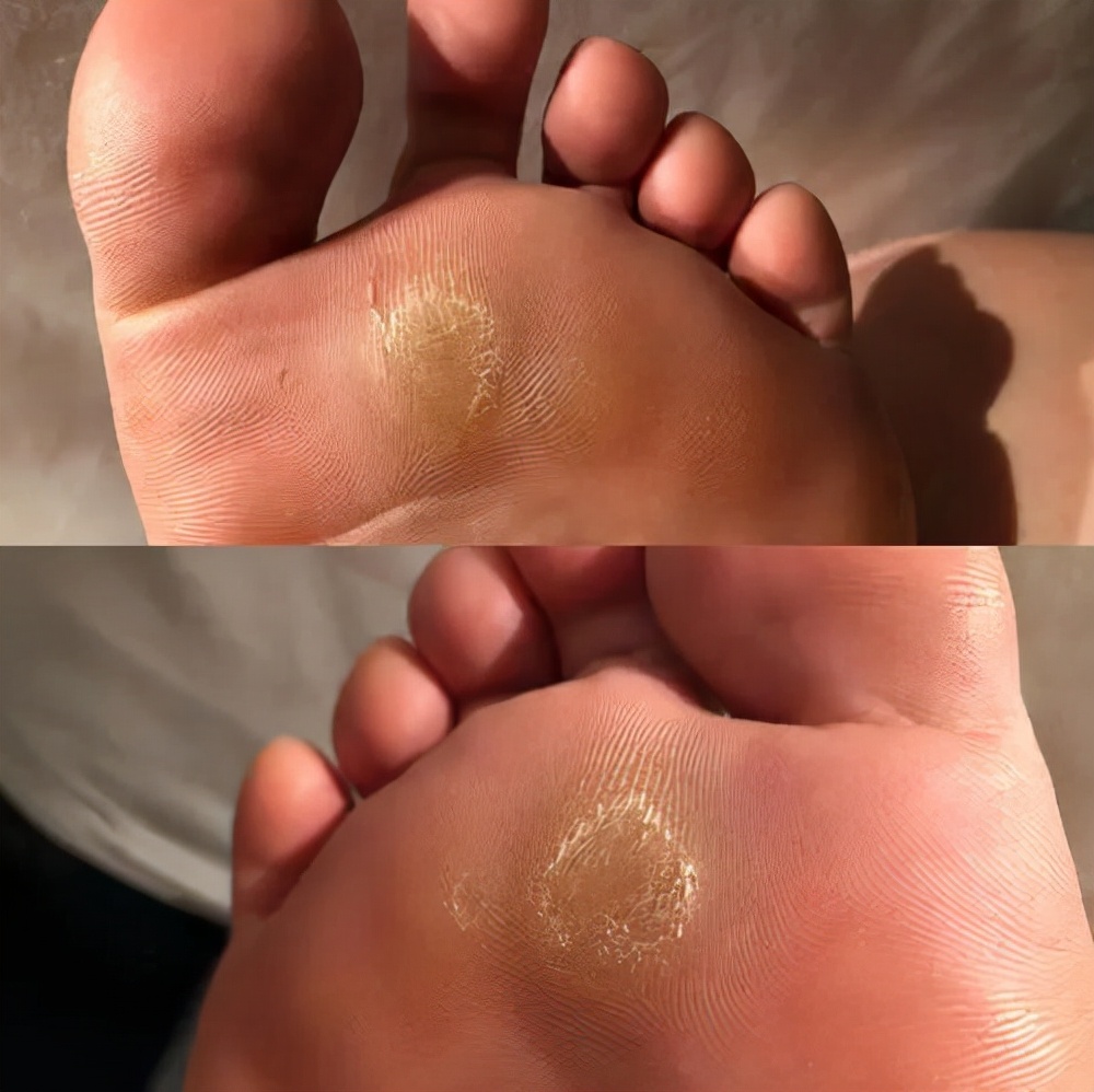 脚底板爱生茧子,走路疼痛是怎么回事?或是这些部位出现了问题