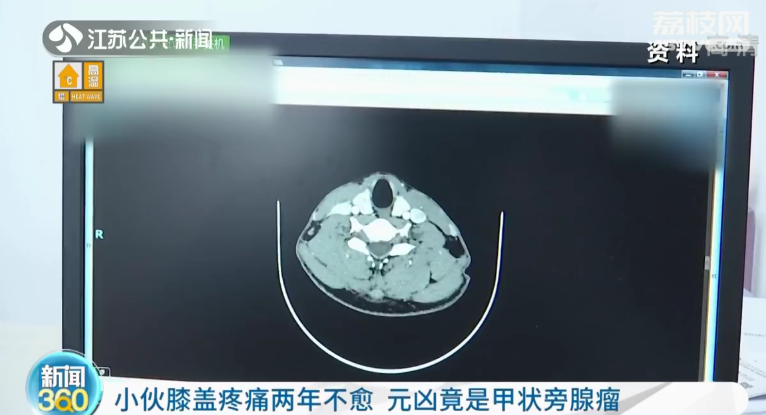 南京小伙膝盖疼痛两年不愈 元凶竟是甲状旁腺瘤