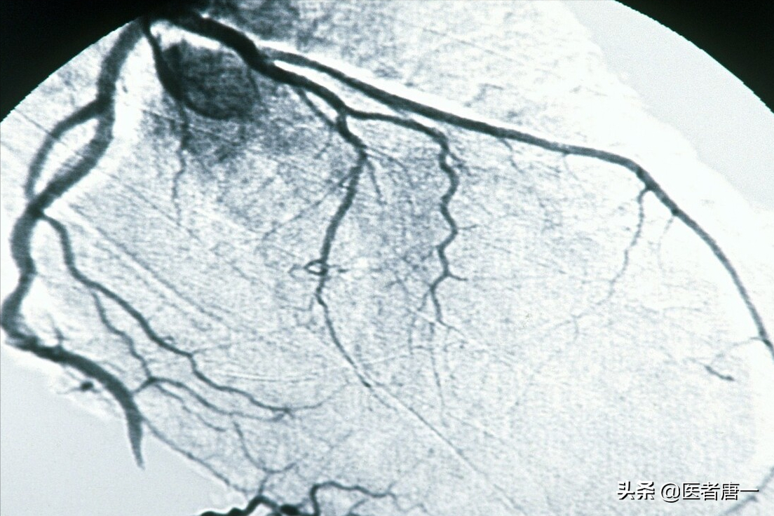做冠脉造影检查后寿命变短？听听医生怎么说