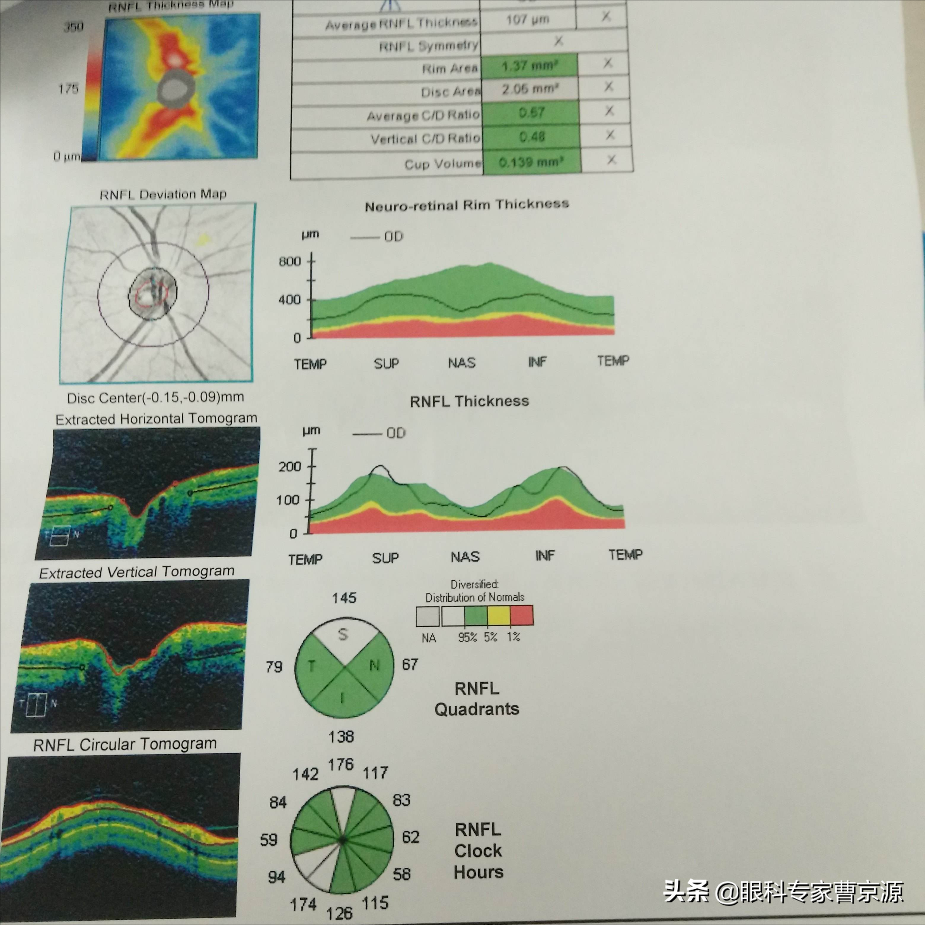 oct黄斑厚度图正常范围图片