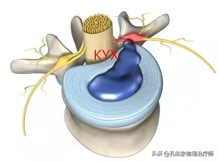 同样是腰椎间盘突出，为什么有人痛不欲生，有人却安然无恙？