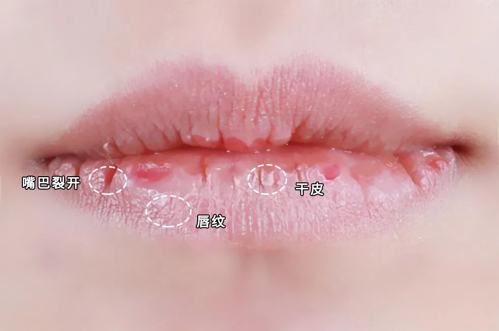 唇部去角质的有效方法 唇部基础护肤要如何做？