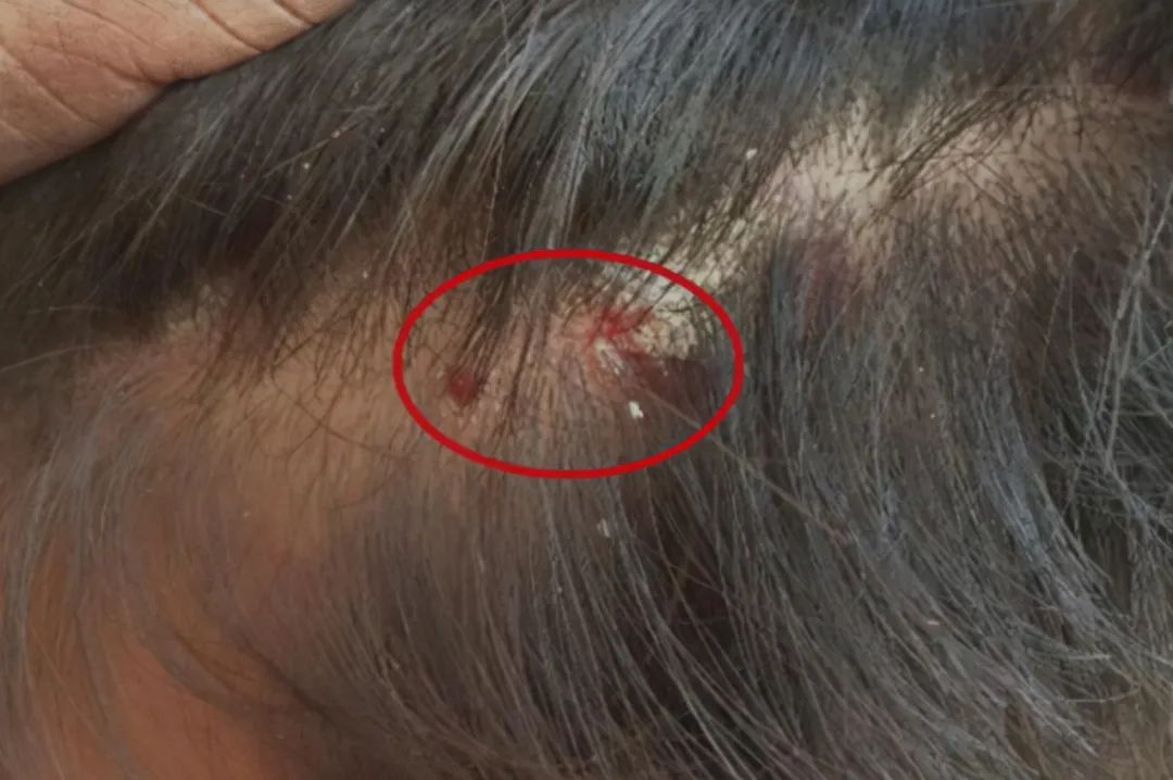 多见于头皮,在刚开始的时候,头发毛囊周边会出现炎症性丘疹,随着病情