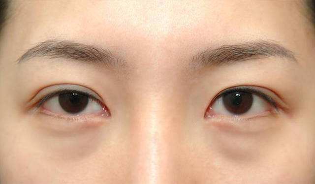 有眼袋怎么办怎么样能让眼袋消失