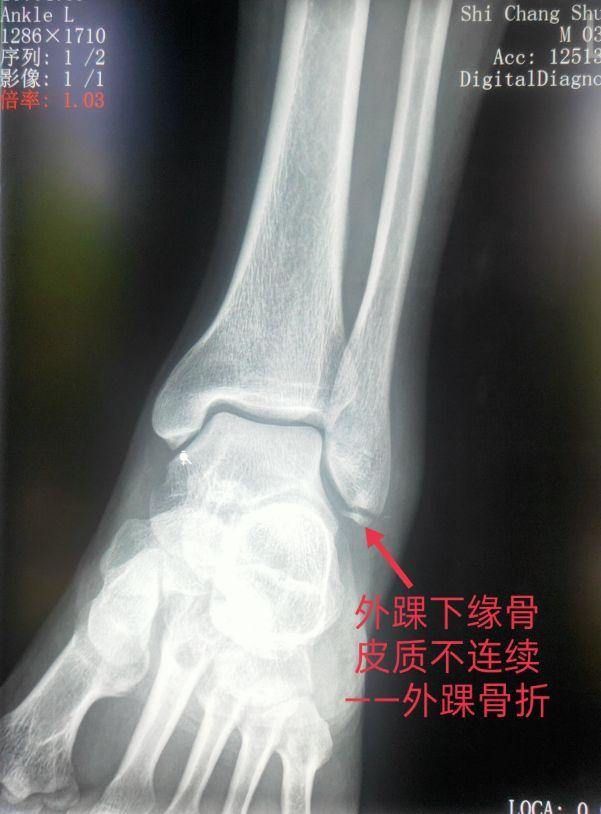 脚踝是哪个部位图解，脚踝是哪个部位图解视频（学习《X线读片指南》骨、关节系统——踝关节）