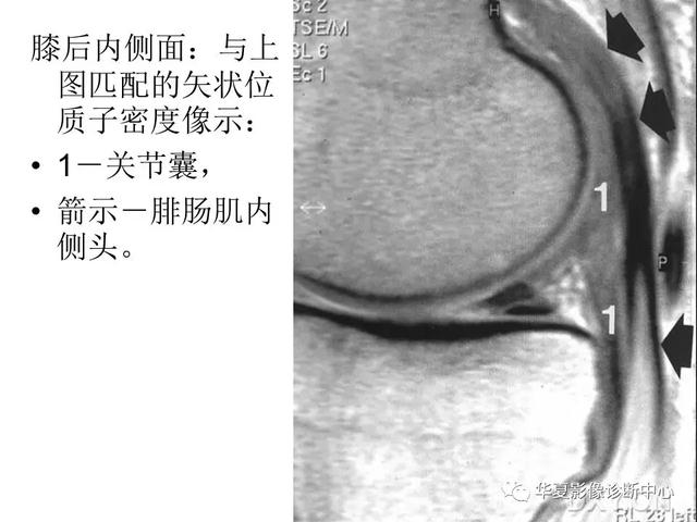 膝关节解剖结构图，膝盖解剖图示意图（膝关节MRI之正常解剖综述）