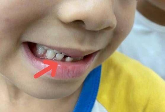 地包天图片,"地包天"的理想矫正时间不是换牙后